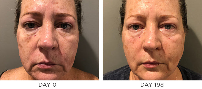 Before and After Results showing improvement in pigmentation liver spots and aging.