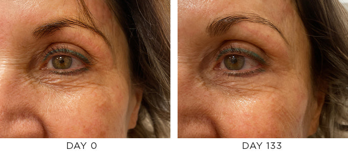 Before and After showing improvement in the appearance of Fine Lines and Wrinkles