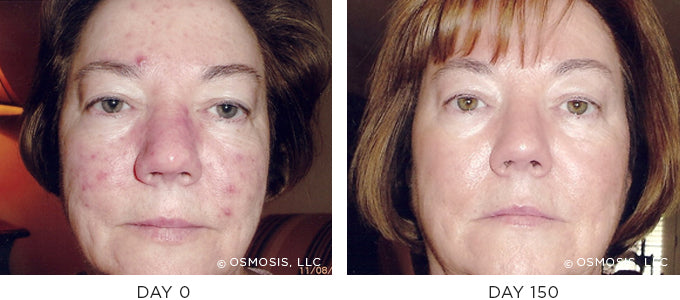 Before and After results showing improvement of blemish-prone and oily skin