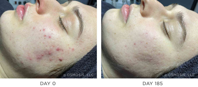 Before & After Results Showing Improvement in Acne