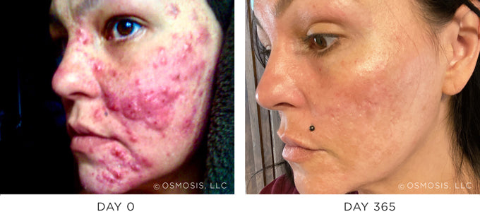 Before and After Photos of Cystic Acne Recovery