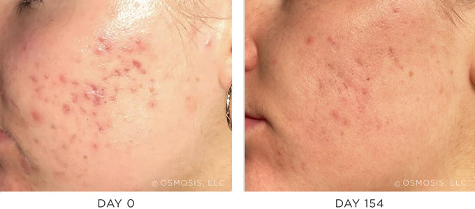 Before and After Acne Scarring Results