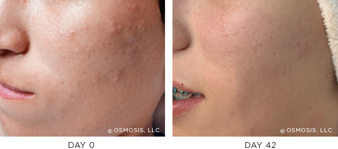 Before and After Photos - Acne