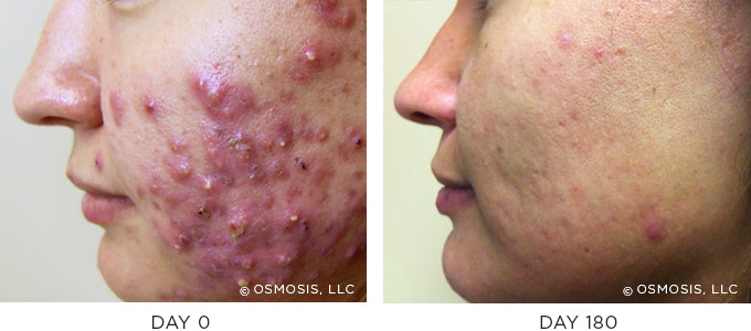 Before and After results showing improvement of blemish-prone and oily skin