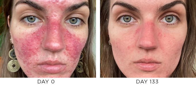 Before and after image showing improvement in acne and rosacea