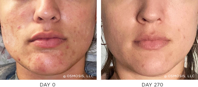 Before and After photos - Acne