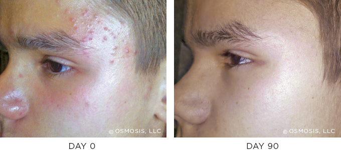 Before and After results showing improvement of blemish-prone and oily skin