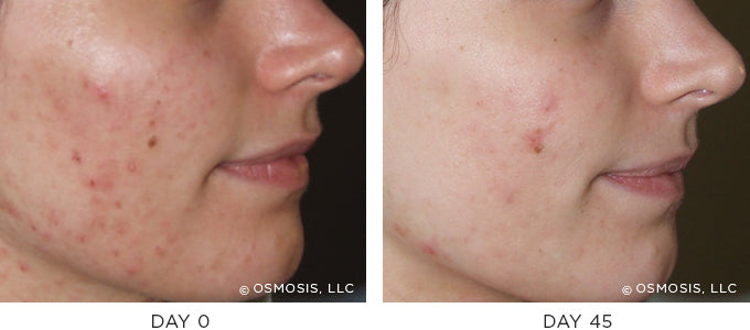 Before and After results showing improvement of blemish-prone and oily skin