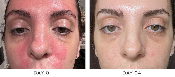 Before and After Results showing improvement in Seborrheic Dermatitis