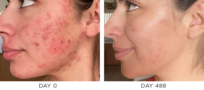 Before and After photo showing improvement in blemish-prone skin