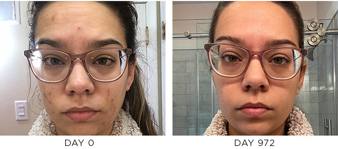 Before and after image showing improvement in acne