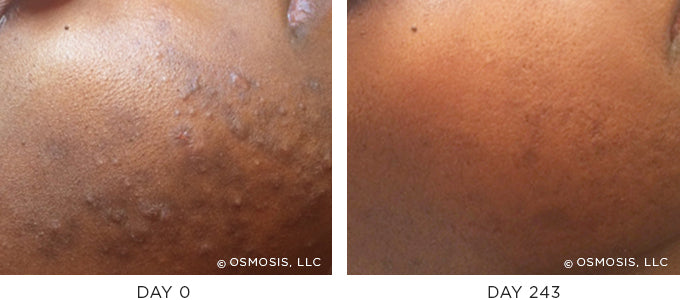 Before and After results showing improvement of blemish-prone and oily skin