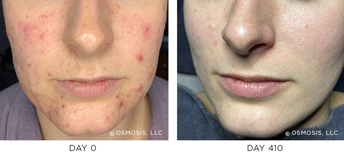 Before and After Cystic Acne