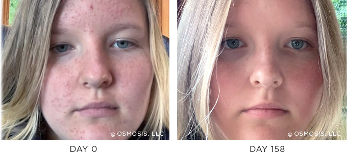 Before and After results showing improvement of blemish-prone and oily skin