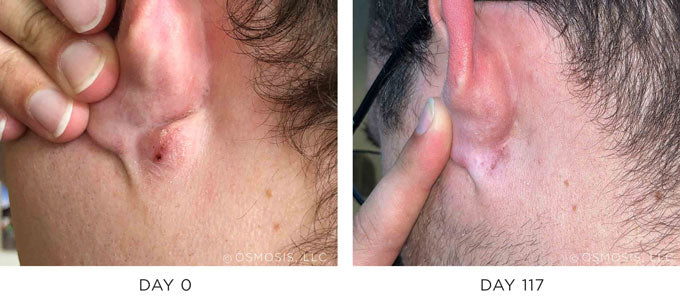 Before and After Results Showing Improvement in Fluid Filled Vesicle/Cyst Behind Ear