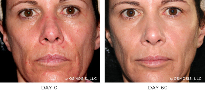 Before and After photo showing improvement in redness and irritation