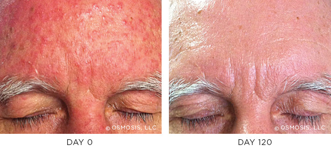 Before and After photo showing improvement in redness and irritation