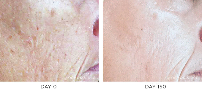 Scarring Before and After Results - Texture