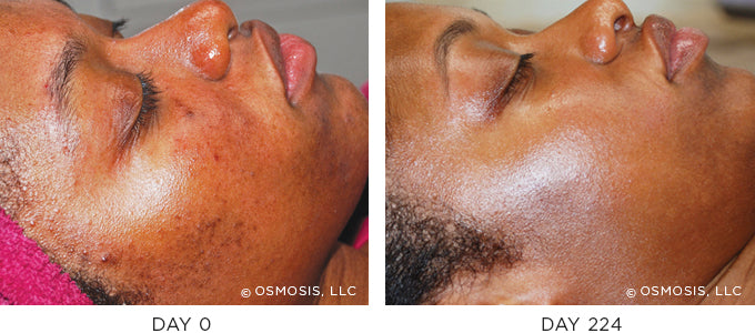 Before and After photo showing improvement in pigmentation and uneven skin tone