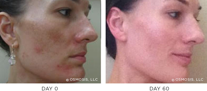 Before and After photo showing improvement in pigmentation and uneven skin tone