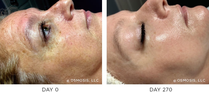 Before and After Photos - Pigmentation, Aging, and Post-Cancer Skin