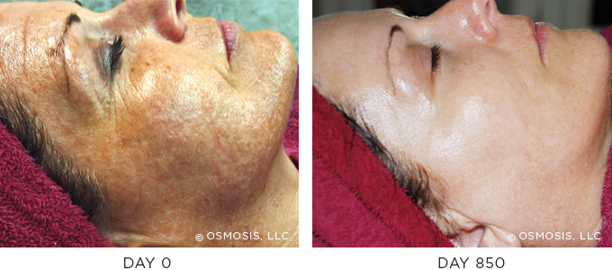 Before and After photo showing improvement in pigmentation and uneven skin tone