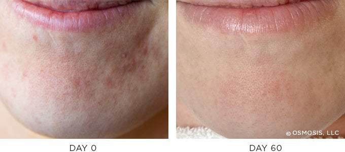 Before and After photo showing improvement in redness and irritation