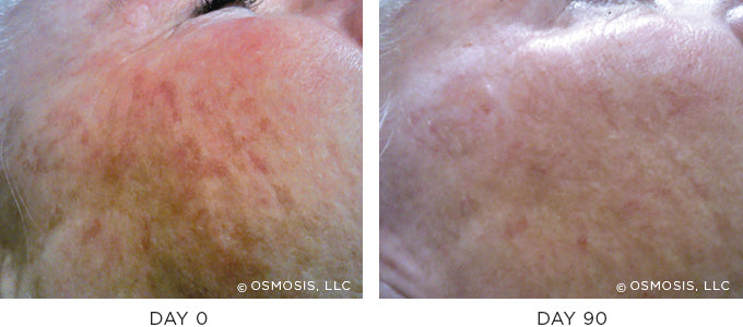 Scarring Before and After Results - Texture