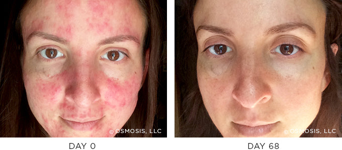 Before and After photo showing improvement in redness and irritation